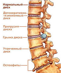 Остеохондроз