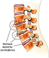 Остеофиты