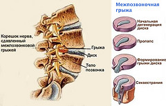 Межпозвоночная грыжа