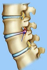 Лечение межпозвоночной грыжи