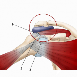Механизм ущемления сухожилий мышц при отведении руки 1-надостная мышца 2-двуглавая мышца 3-подлопаточная мышца