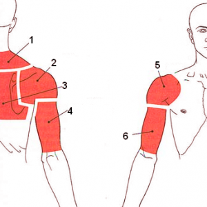 Болевые зоны в зависимости от вовлечения мышц в воспалительный процесс:  1-надостная мышца 2-подостная мышца 3-подлопаточная мышца 4-двуглавая мышца 5-дельтовидная мышца 6-трёхглавая мышца