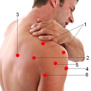 Болевые зоны в зависимости от вовлечения мышц в воспалительный процесс: 1-надостная мышца 2-подостная мышца 3-подлопаточная мышца 4-двуглавая мышца 5-дельтовидная мышца 6-трёхглавая мышца